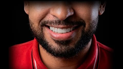 Sorriso depois das facetas em resina