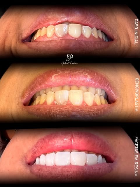 Três etapas de um tratamento: caso inicial, gengivoplastia e facetas em resina