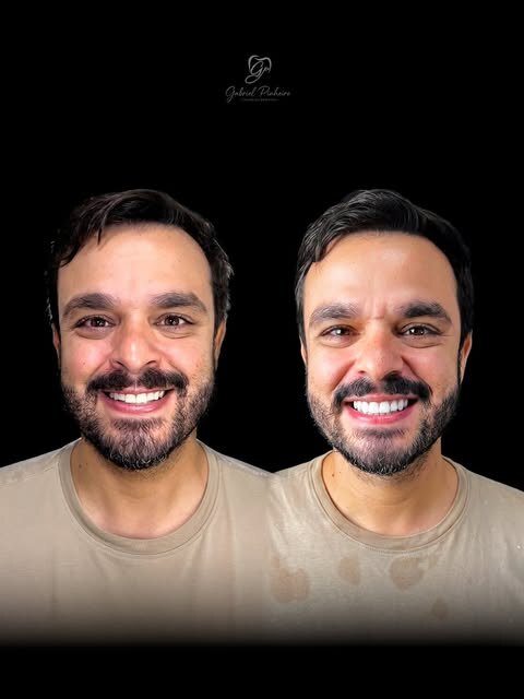 Paciente antes e depois das facetas em resina